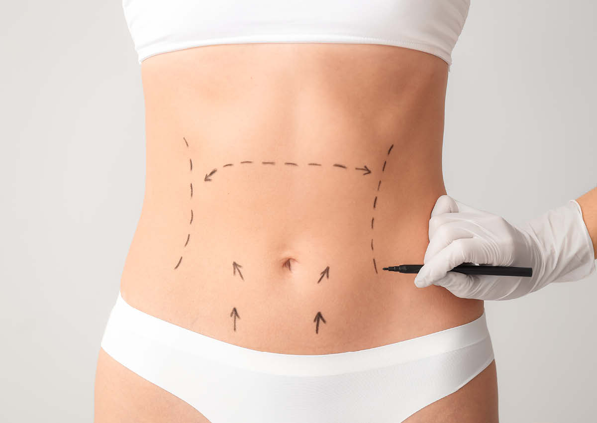 Abdominoplasty, commonly known as a tummy tuck, is a surgical procedure that removes excess fat and skin from the abdomen while also tightening the abdominal muscles to create a smoother and firmer abdominal contour.